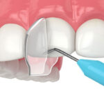 Root canal treatment cost Dubai