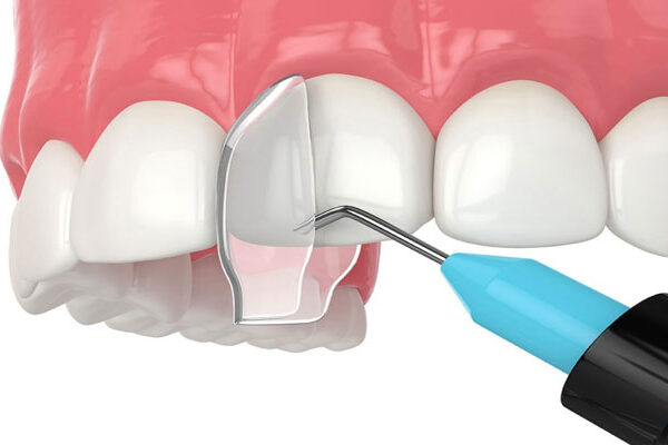 Root canal treatment cost Dubai
