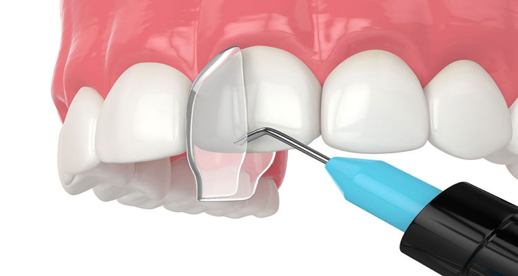 Root canal treatment cost Dubai