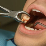 Zoom whitening Dubai