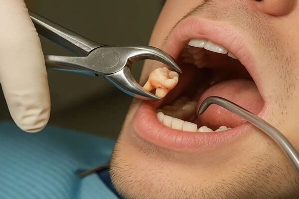 Zoom whitening Dubai