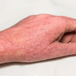 eczema treatment Dubai