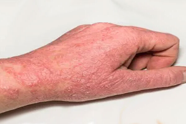 eczema treatment Dubai