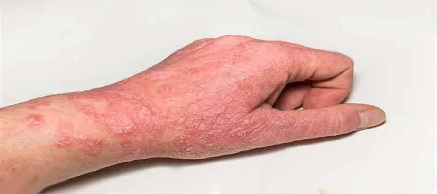 eczema treatment Dubai